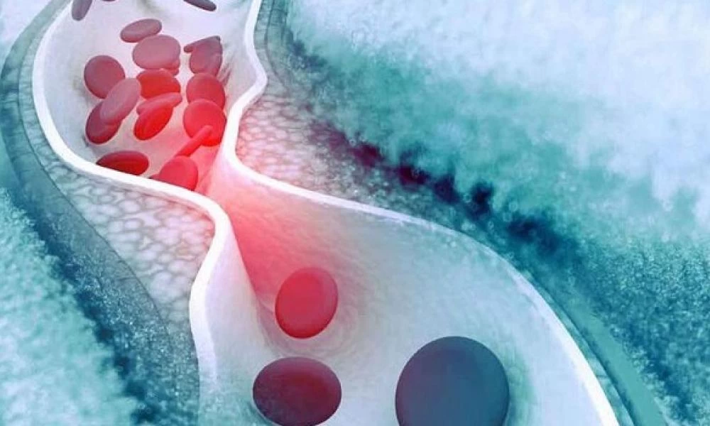 Τριγλυκερίδια: Πώς να τα μειώσετε χωρίς φάρμακα